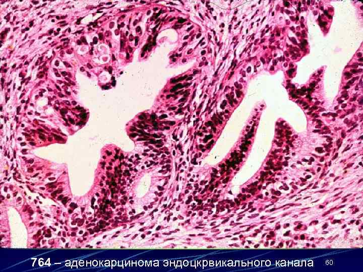 764 – аденокарцинома эндоцкрвикального канала 60 