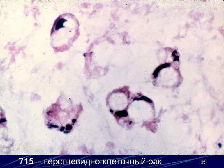 715 – перстневидно-клеточный рак 65 