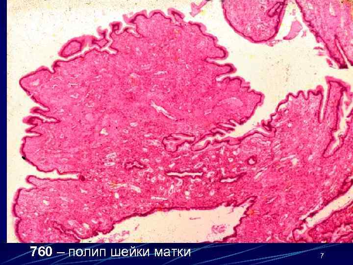 760 – полип шейки матки 7 