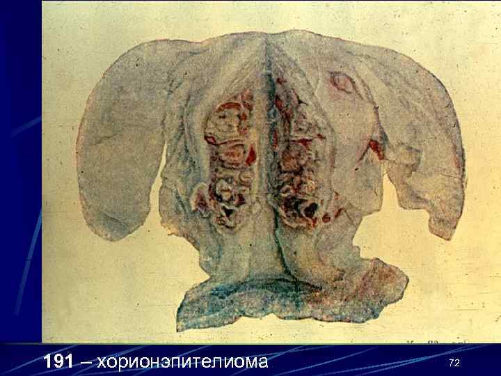 191 – хорионэпителиома 72 