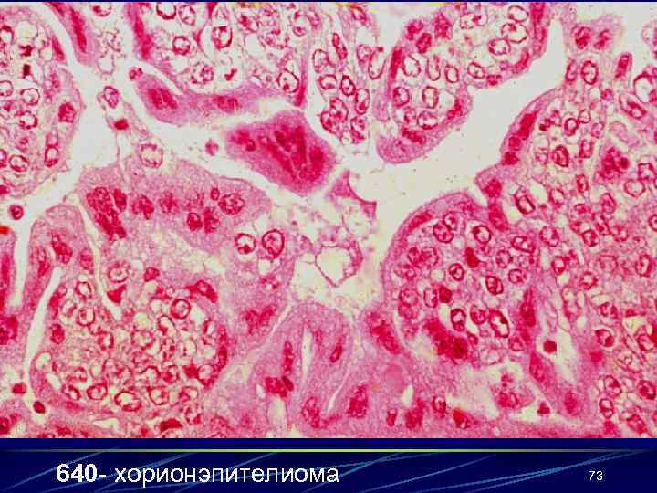 640 - хорионэпителиома 73 