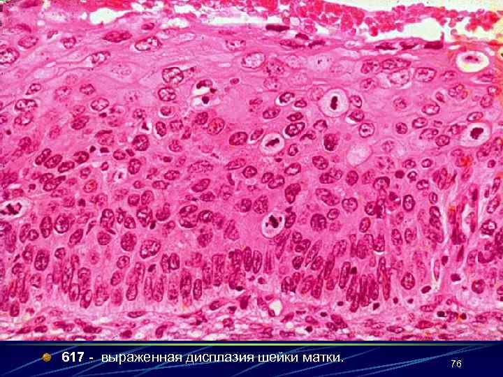 617 - выраженная дисплазия шейки матки. 76 