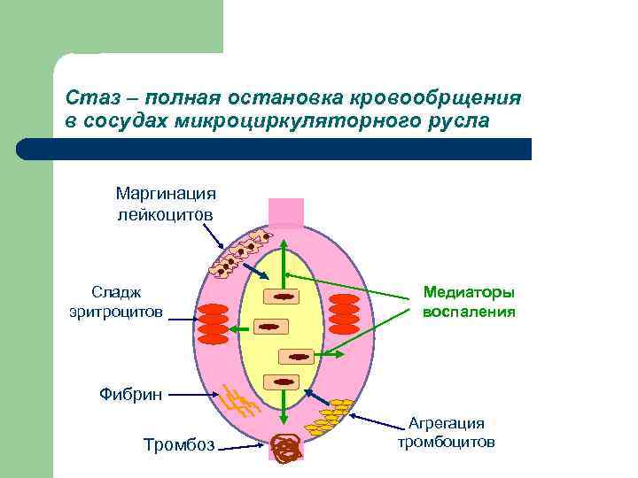 Стаз – полная остановка кровообрщения в сосудах микроциркуляторного русла  Маргинация лейкоцитов  Сладж
