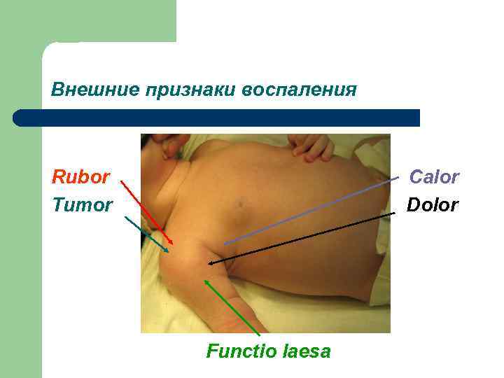 Внешние признаки воспаления  Rubor     Calor Tumor   