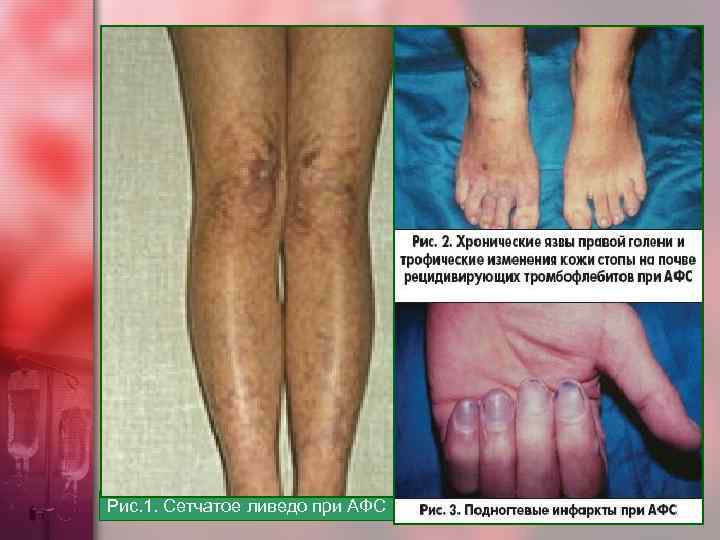 Рис. 1. Сетчатое ливедо при АФС 