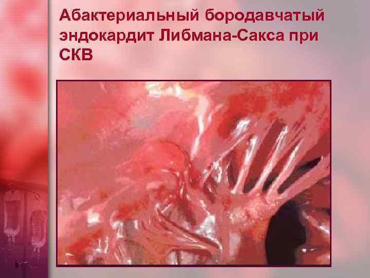 Абактериальный бородавчатый эндокардит Либмана-Сакса при СКВ 