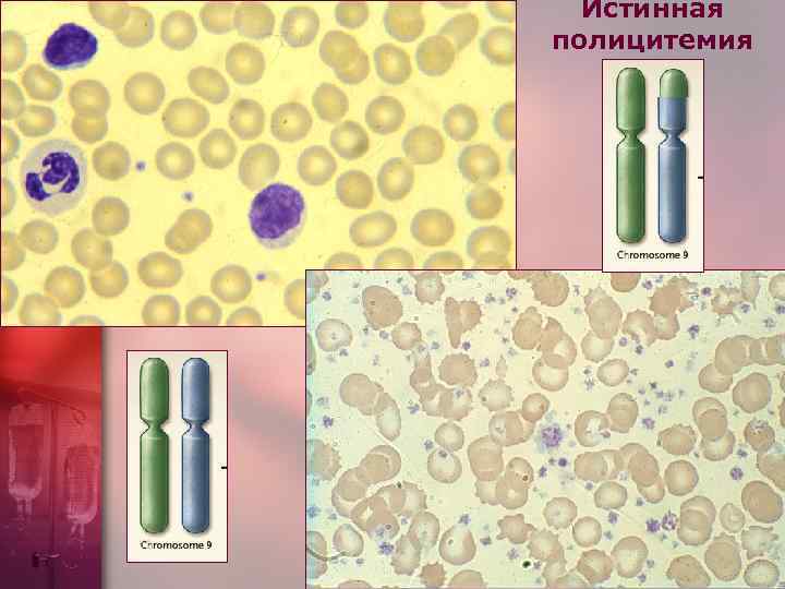  Истинная полицитемия 