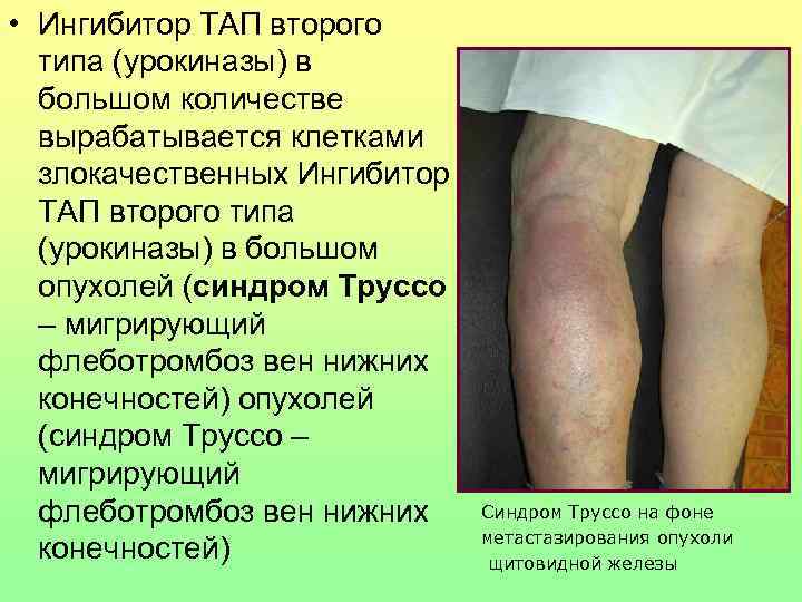  • Ингибитор ТАП второго  типа (урокиназы) в  большом количестве  вырабатывается