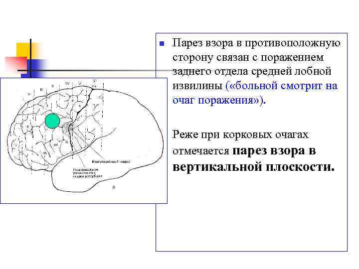 Центр горизонтального. Корковый парез взора. Парез взора в противоположную сторону. Корковый и стволовой парез взора. Корковый центр взора.