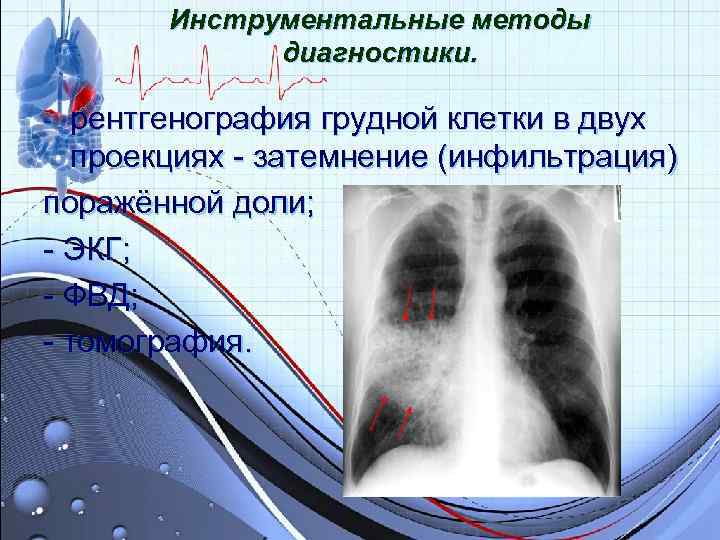 Инструментальные методы диагностики. - рентгенография грудной клетки в двух Инструментальные методы диагностики. - рентгенография грудной клетки в двух