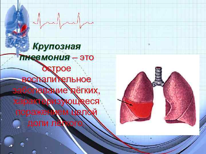 Крупозная пневмония – это острое воспалительное заболевание лёгких, характеризующееся поражением Крупозная пневмония – это острое воспалительное заболевание лёгких, характеризующееся поражением