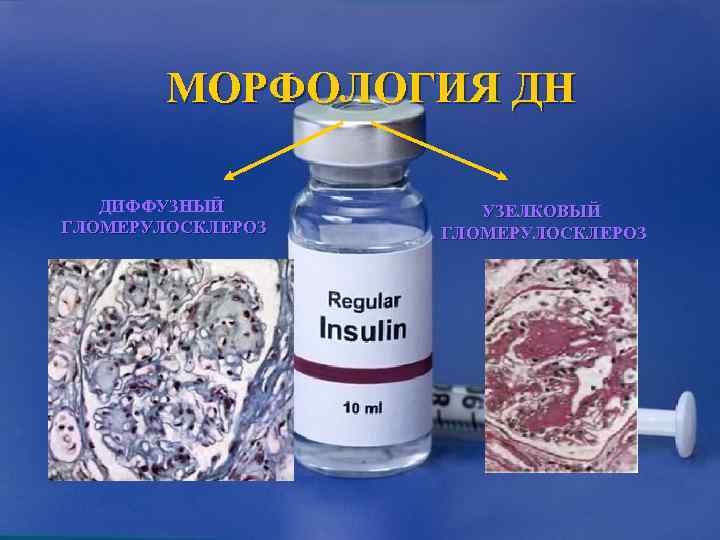   МОРФОЛОГИЯ ДН ДИФФУЗНЫЙ   УЗЕЛКОВЫЙ ГЛОМЕРУЛОСКЛЕРОЗ 