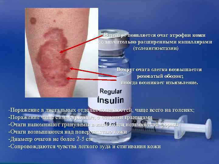        В центре появляется очаг атрофии кожи 