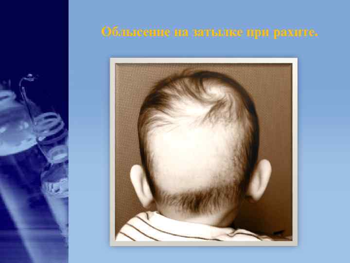 Облысение на затылке при рахите. Облысение на затылке при рахите.