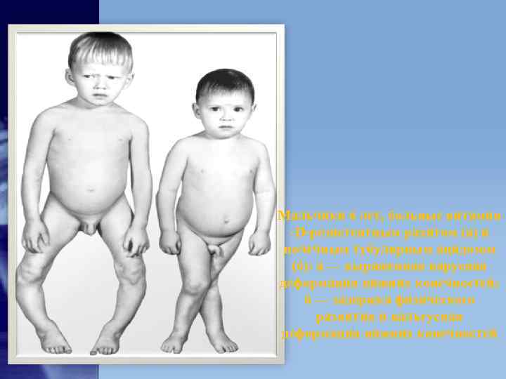 Мальчики 6 лет, больные витамин -D-резистентным рахитом (а) и почечным тубулярным ацидозом Мальчики 6 лет, больные витамин -D-резистентным рахитом (а) и почечным тубулярным ацидозом