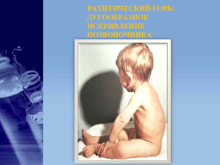 РАХИТИЧЕСКИЙ ГОРБ: ДУГООБРАЗНОЕ ИСКРИВЛЕНИЕ ПОЗВОНОЧНИКА РАХИТИЧЕСКИЙ ГОРБ: ДУГООБРАЗНОЕ ИСКРИВЛЕНИЕ ПОЗВОНОЧНИКА