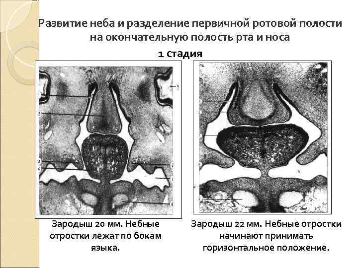 Развитие неба и разделение первичной ротовой полости   на окончательную полость рта и
