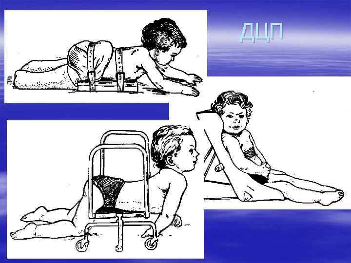 ДЦП 