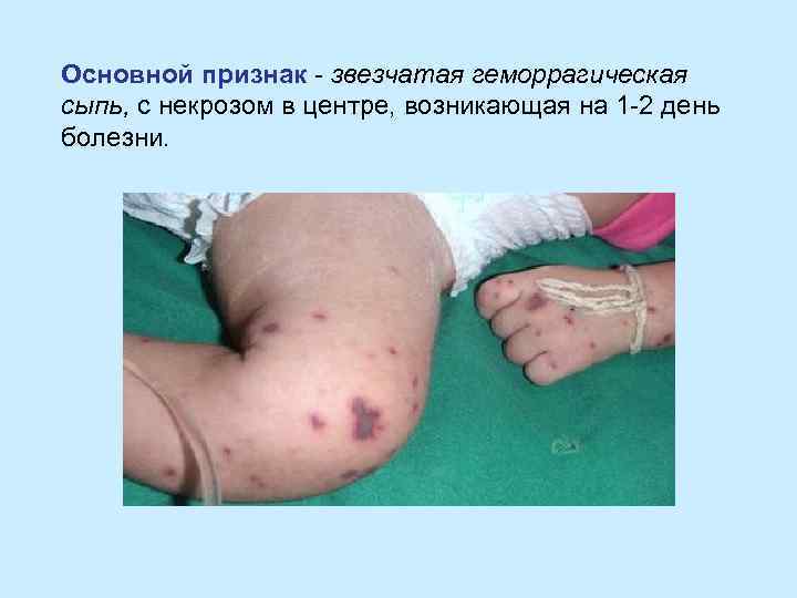 Основной признак - звезчатая геморрагическая сыпь, с некрозом в центре, возникающая на 1 -2