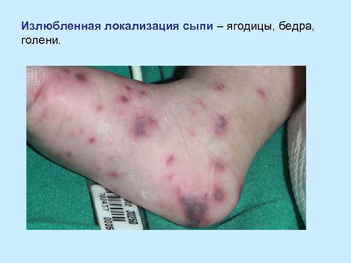 Излюбленная локализация сыпи – ягодицы, бедра, голени. 