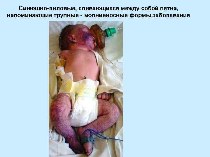   Синюшно-лиловые, сливающиеся между собой пятна, напоминающие трупные - молниеносные формы заболевания 