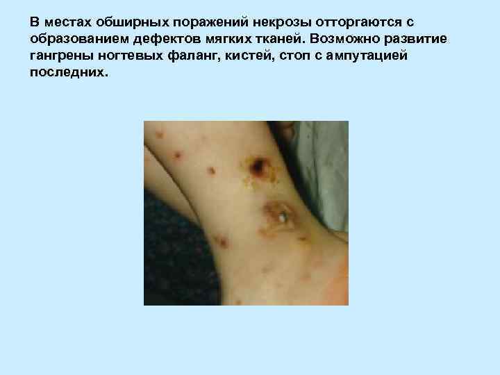 В местах обширных поражений некрозы отторгаются с образованием дефектов мягких тканей. Возможно развитие гангрены