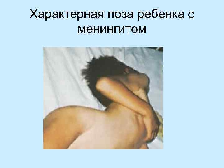 Характерная поза ребенка с  менингитом 