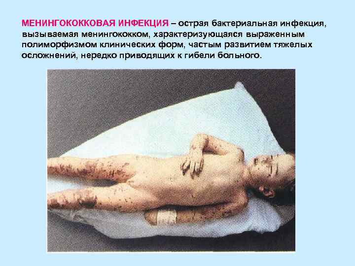 МЕНИНГОКОККОВАЯ ИНФЕКЦИЯ – острая бактериальная инфекция, вызываемая менингококком, характеризующаяся выраженным полиморфизмом клинических форм, частым