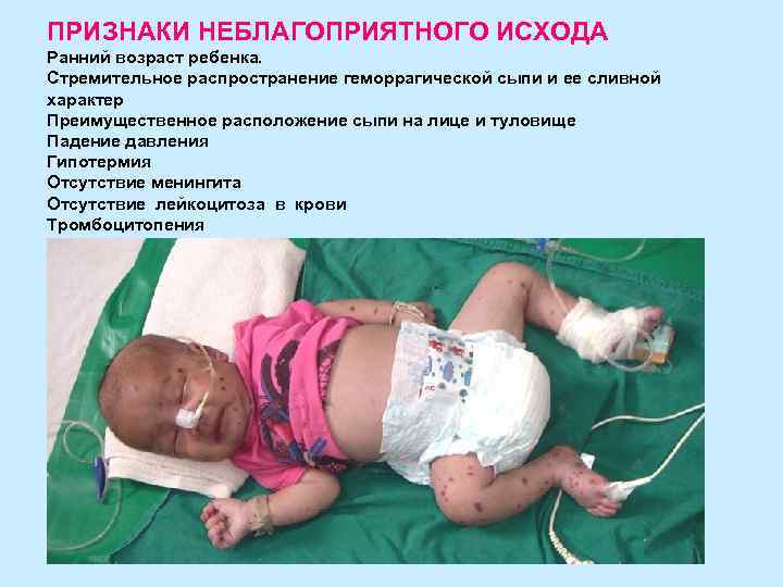 ПРИЗНАКИ НЕБЛАГОПРИЯТНОГО ИСХОДА Ранний возраст ребенка. Стремительное распространение геморрагической сыпи и ее сливной характер