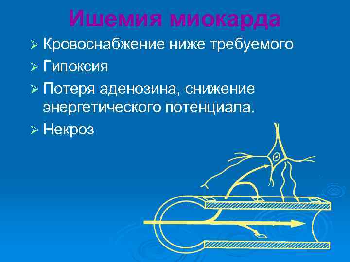 Ишемия миокарда Ø Кровоснабжение ниже требуемого Ø Гипоксия Ø Потеря аденозина, снижение Ишемия миокарда Ø Кровоснабжение ниже требуемого Ø Гипоксия Ø Потеря аденозина, снижение