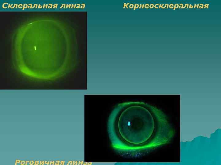 Склеральная линза  Корнеосклеральная  линза 