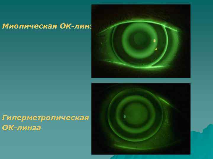 Миопическая ОК-линза Гиперметропическая ОК-линза 