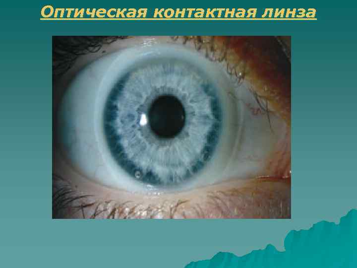 Оптическая контактная линза 
