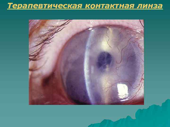 Терапевтическая контактная линза 