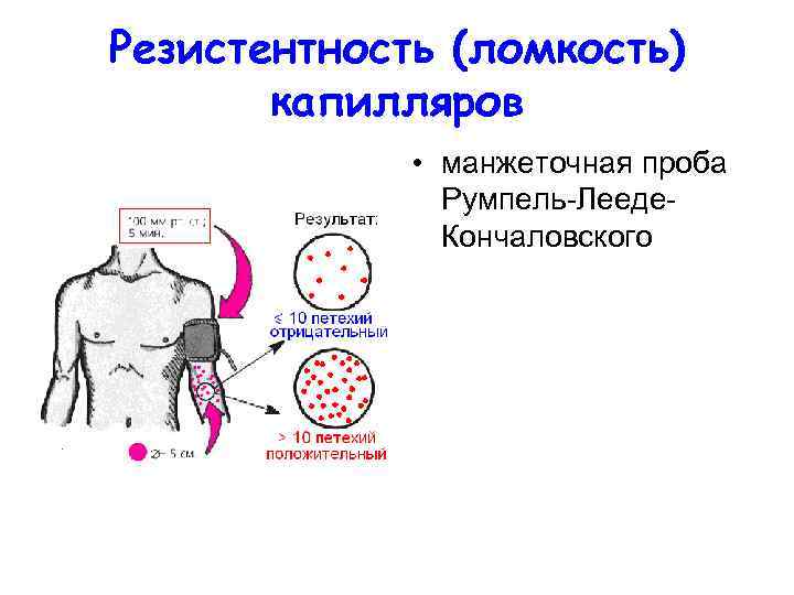 Резистентность (ломкость)  капилляров    • манжеточная проба   Румпель Лееде