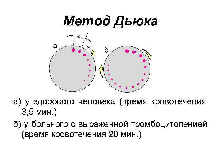   Метод Дьюка а) у здорового человека (время кровотечения  3, 5 мин.