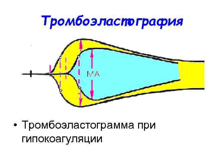   Тромбоэластография • Тромбоэластограмма при  гипокоагуляции 