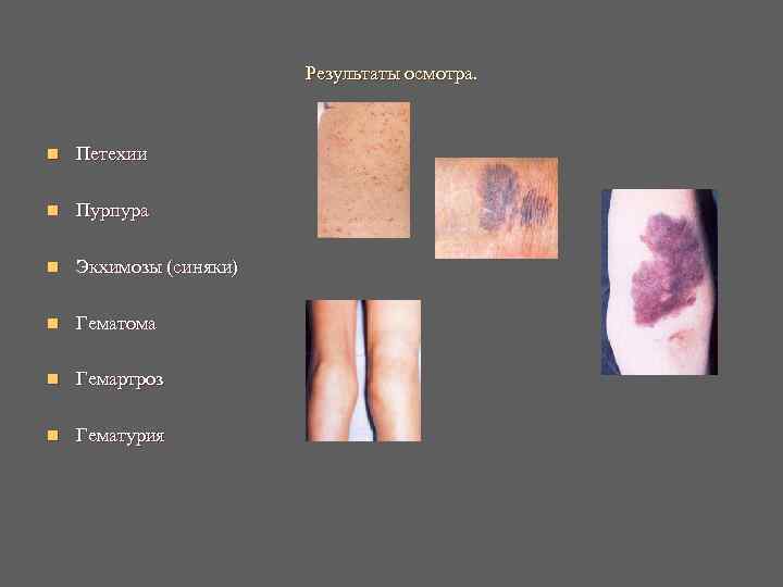 Результаты осмотра. n Петехии n Пурпура n Результаты осмотра. n Петехии n Пурпура n