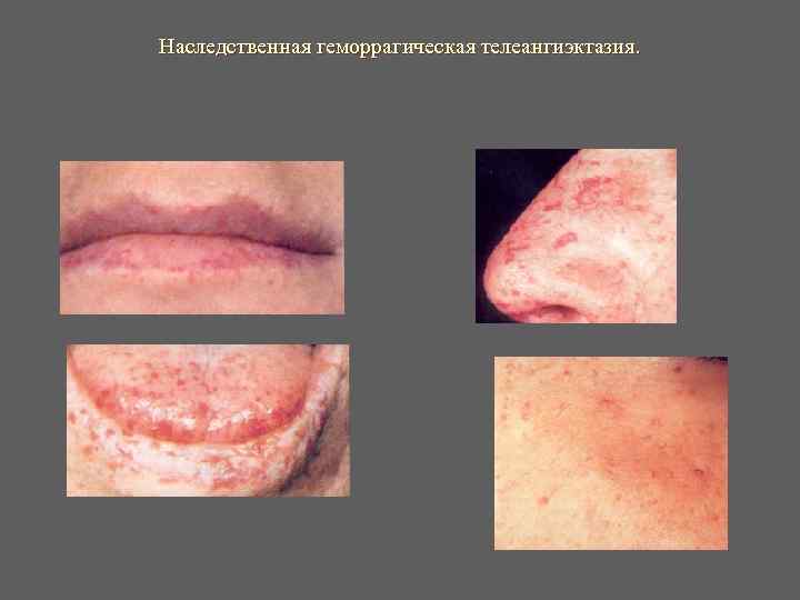 Наследственная геморрагическая телеангиэктазия. Наследственная геморрагическая телеангиэктазия.