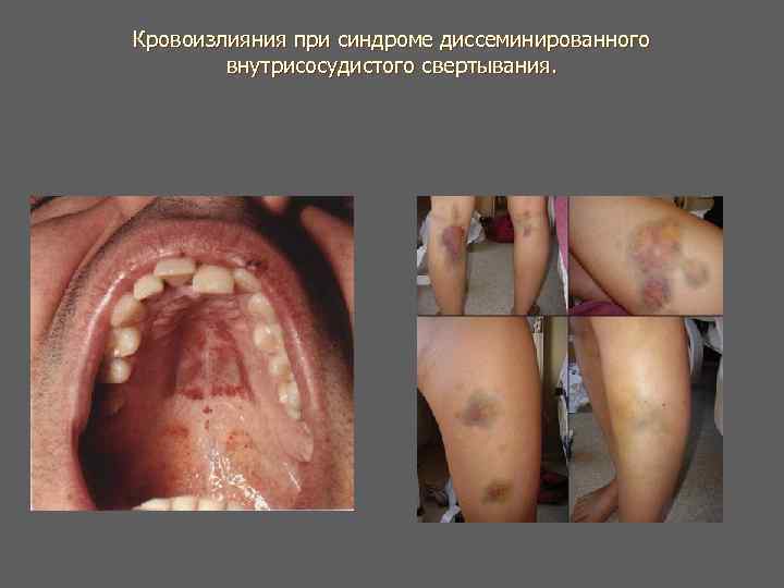 Кровоизлияния при синдроме диссеминированного внутрисосудистого свертывания. Кровоизлияния при синдроме диссеминированного внутрисосудистого свертывания.
