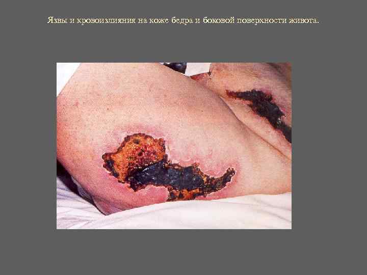 Язвы и кровоизлияния на коже бедра и боковой поверхности живота. Язвы и кровоизлияния на коже бедра и боковой поверхности живота.