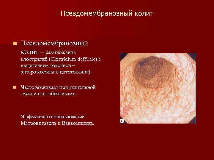      Псевдомембранозный колит  n  Псевдомембранозный колит – размножение