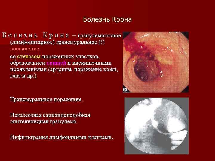       Болезнь Крона Б о л е з н