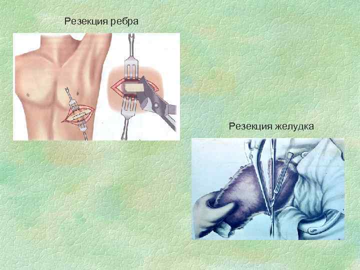 Резекция ребра Резекция желудка 