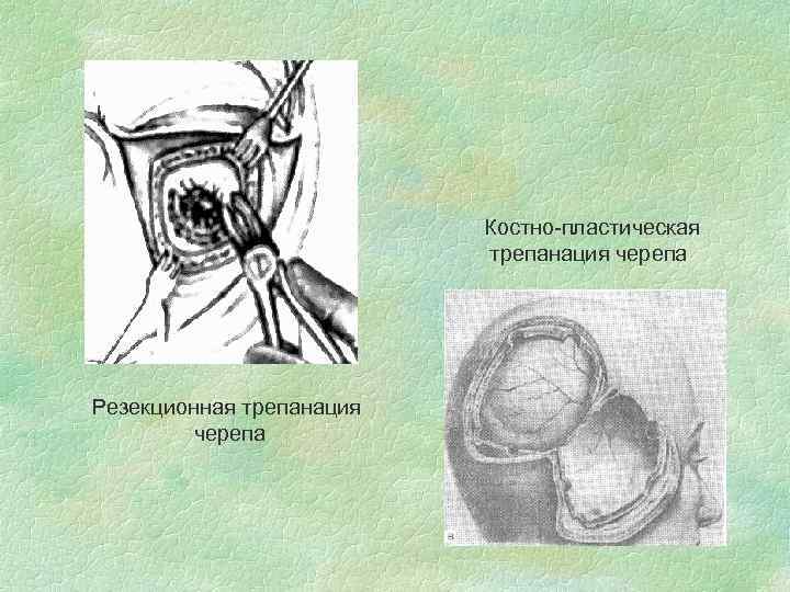 Костно-пластическая трепанация черепа Резекционная трепанация черепа 