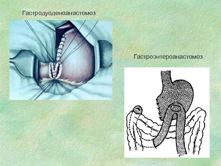 Гастродуоденоанастомоз Гастроэнтероанастомоз 