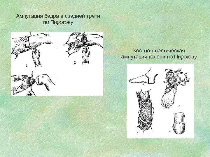 Ампутация бедра в средней трети по Пирогову Костно-пластическая ампутация голени по Пирогову 