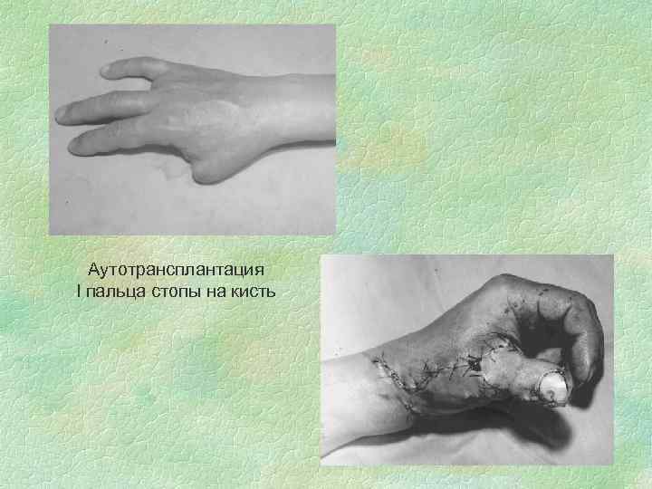 Аутотрансплантация I пальца стопы на кисть 