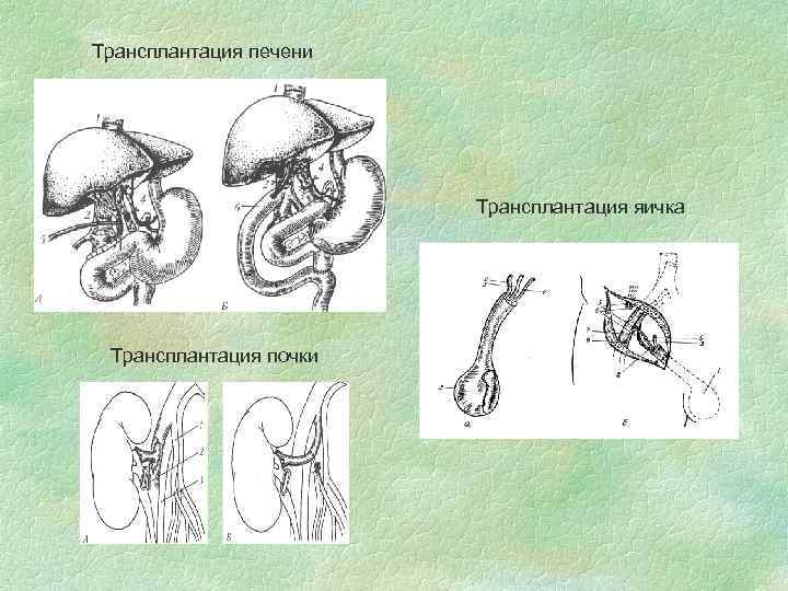 Трансплантация печени Трансплантация яичка Трансплантация почки 