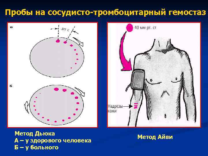 Пробы на сосудисто-тромбоцитарный гемостаз Метод Дьюка Метод Айви Пробы на сосудисто-тромбоцитарный гемостаз Метод Дьюка Метод Айви